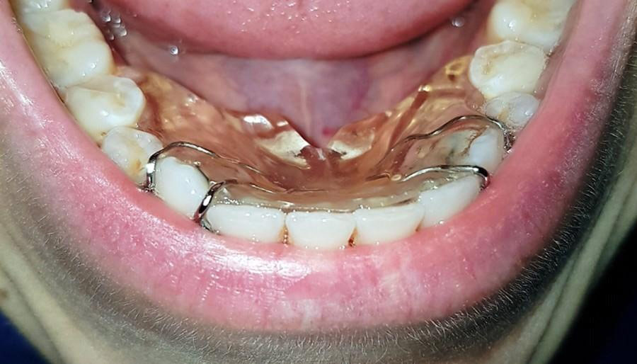 Eliba nella cavit orale